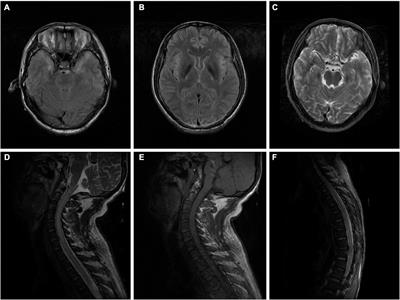 Case Report: Long segmental lesions of the spinal cord caused by exposure to xylene